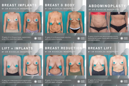 Exercises for Lifted Breasts  Dr. Zochowski Plastic Surgery