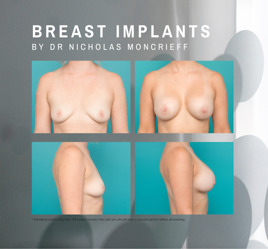 Gallery BeforeAndAfter BreastAugmentation 26-years-7-months-post-breast-augmentation-using-375cc-anatomical-implants-by-Dr-Nicholas-Moncrieff