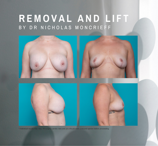 Removal and Lift