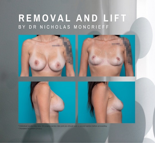 Removal and Lift
