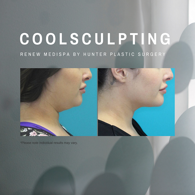 Gallery BeforeAndAfter CoolSculpting 24-year-old-patient-coolsculpting-to-the-chin-6-weeks-post-at-renew-medispa-hunter-plastic-surgery
