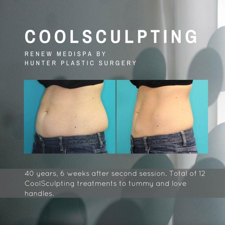Gallery BeforeAndAfter CoolSculpting CoolSculpting-to-tummy-and-love-handles-before-and-after-at-Renew-Medispa-by-Hunter-Plastic-Surgery-40-yr-old-patient-6-weeks-post-procedure