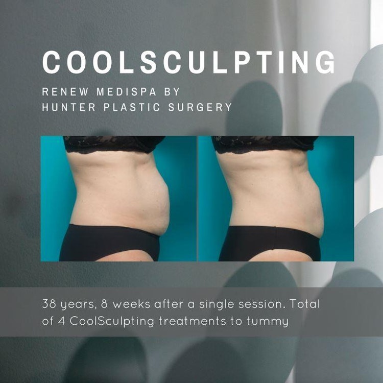 Gallery BeforeAndAfter CoolSculpting CoolSculpting-to-tummy-before-and-after-at-Renew-Medispa-by-Hunter-Plastic-Surgery-38-yr-old-patient-8-weeks-post-procedure