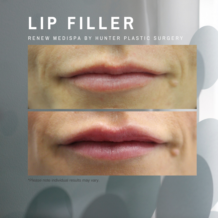 Gallery BeforeAndAfter Injecting 37-year-old-lip-filler-patient-at-renew-medispa-hunter-plastic-surgery-1-week-after
