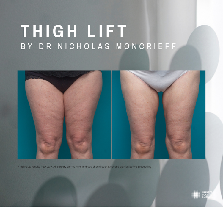  thigh lift surgery