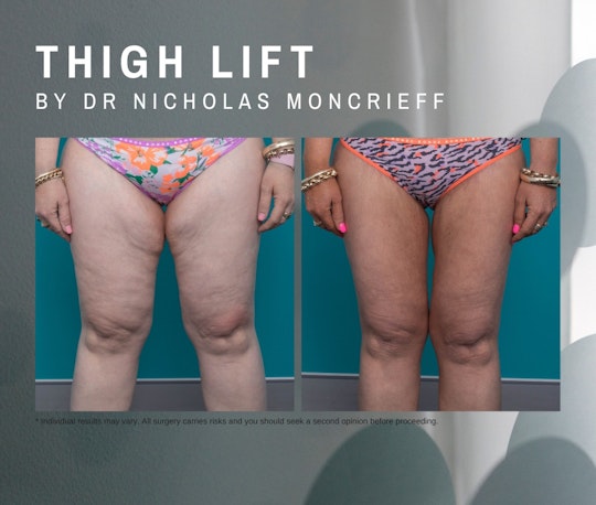 Gallery BeforeAndAfter PostMassWeightLoss cropped-images 38-year-old-patient-9-months-post-thigh-lift-by-Dr-Nicholas-Moncrieff-at-Hunter-Plastic-surgery-83-35-1028-872-1693890105