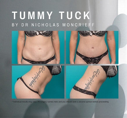 32-year-old-10-weeks-post-Tummy-tuck-before-and-after-by-Dr-Nicholas-Moncrieff-at-Hunter-Plastic-Surgery-website-gallery