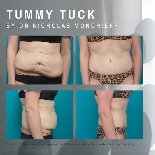 This patient had an abdominoplasty with muscle tightening, skin removal and waist sculpting