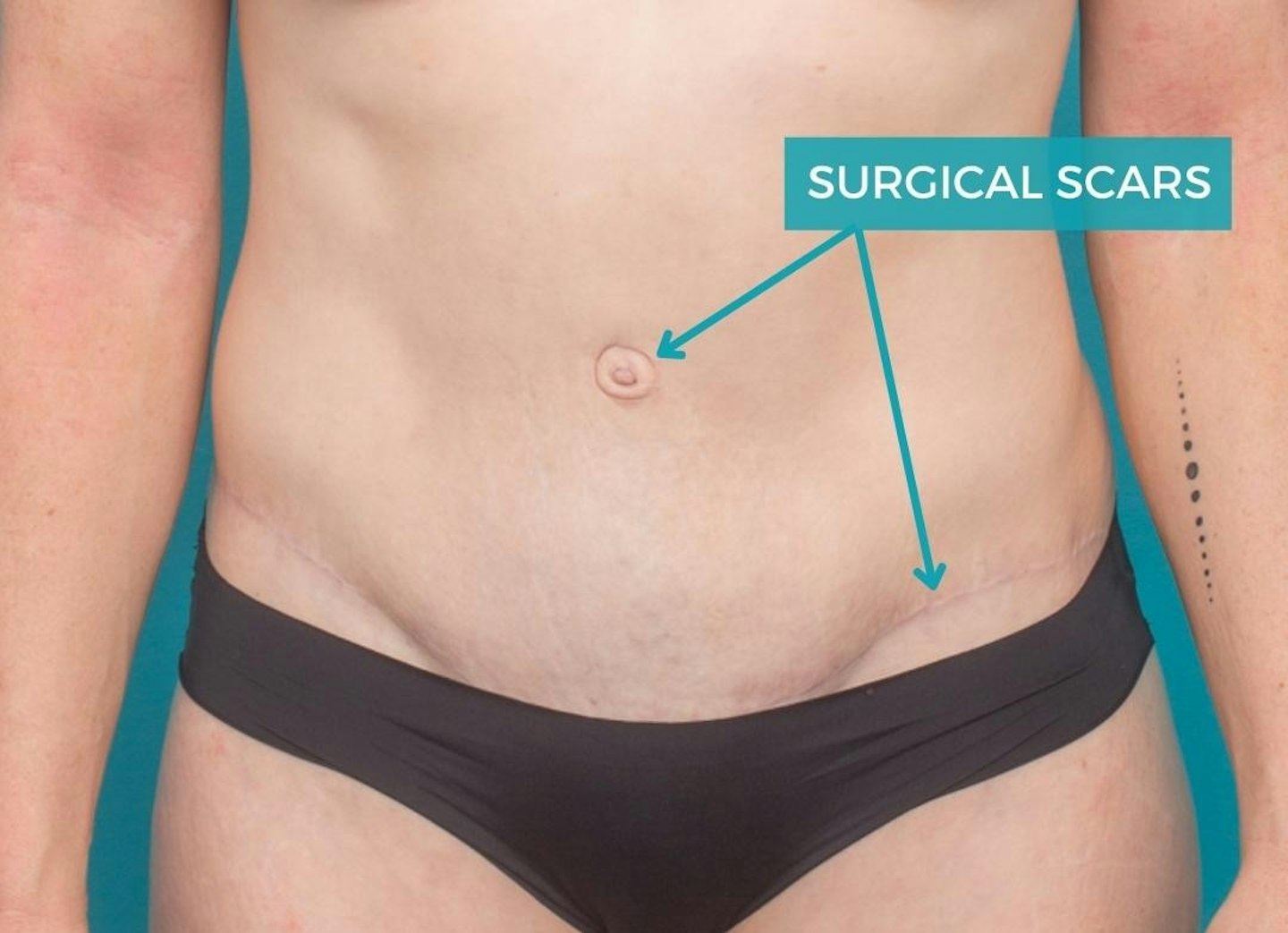 Tummy Tuck Scars: What to Expect, Berman Cosmetic Surgery