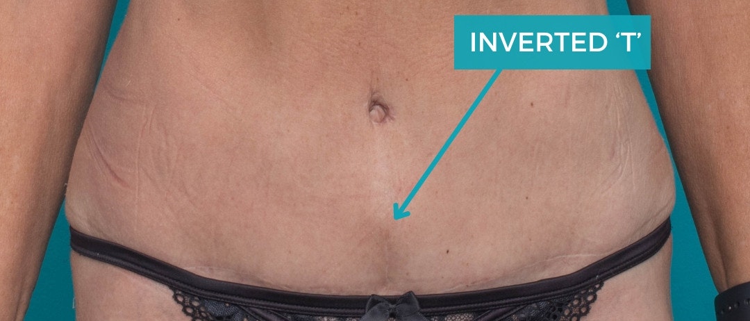 Will I need an inverted T scar with my abdominoplasty?
