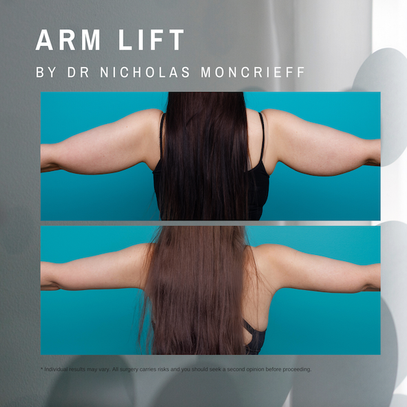 arm lift surgery newcastle