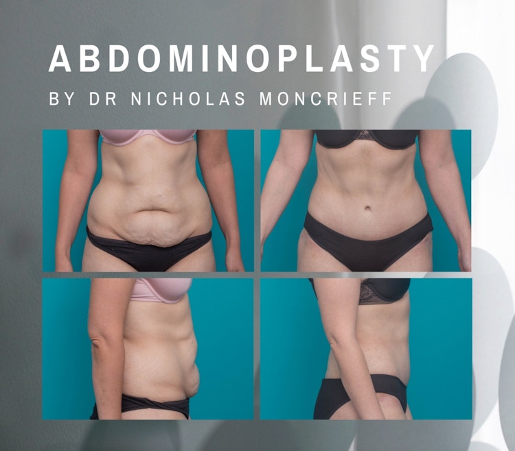 abdominoplasty by Dr Nicholas Moncrieff