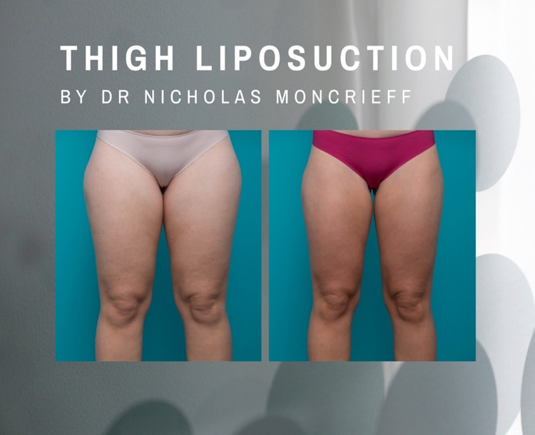 Procedures Body cropped-images 30-years-old-4-months-post-liposuction-to-bilateral-thighs-by-Dr-Nicholas-Moncrieff-Hunter-Plastic-Surgery-0-0-1079-878-1697671282