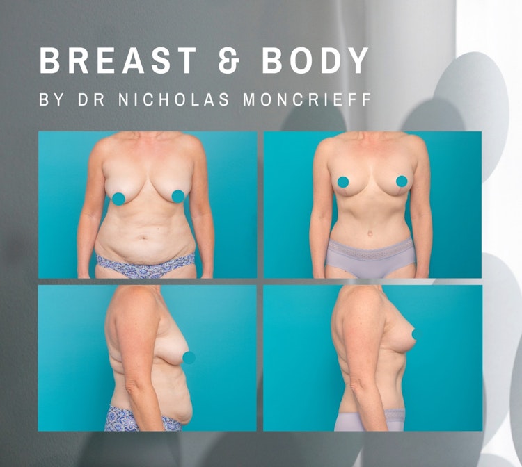 Breast and body plastic surgery post pregnancy