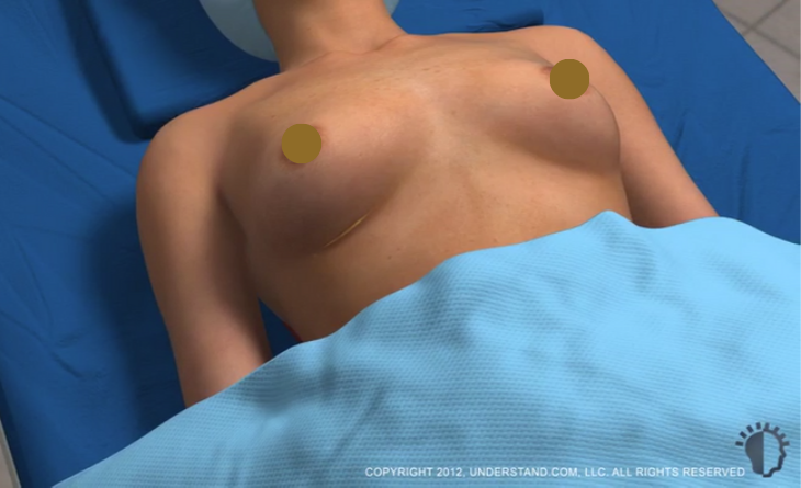 Click on image to watch Breast Augmentation video