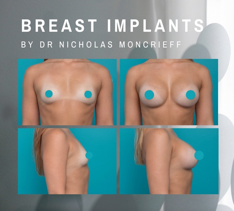 Breast augmentation dr moncrieff