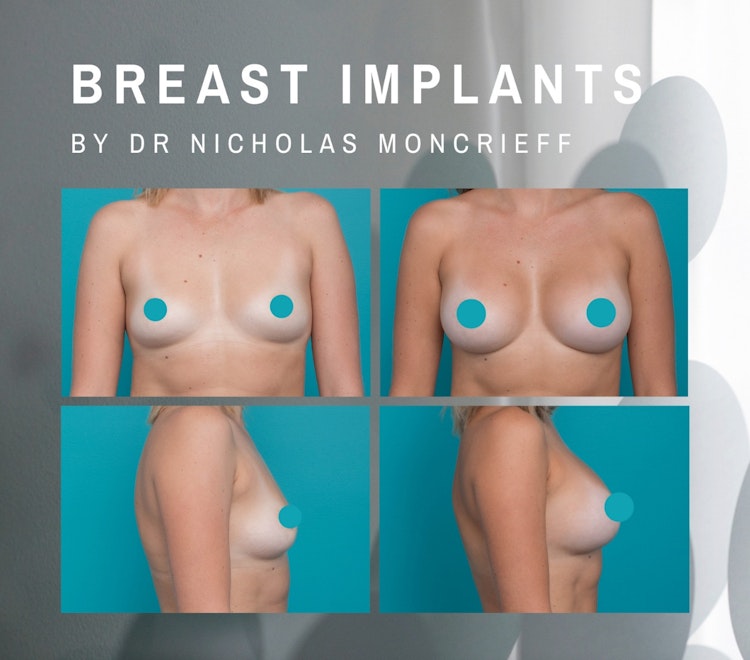 Breast augmentation hunter plastic surgery