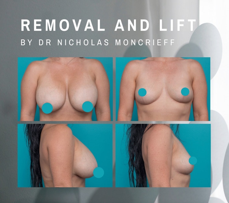 Breast Implant removal and uplift including nipple reshaping before and after