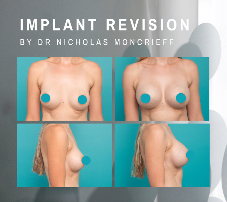 Breast Implant Replacement Result