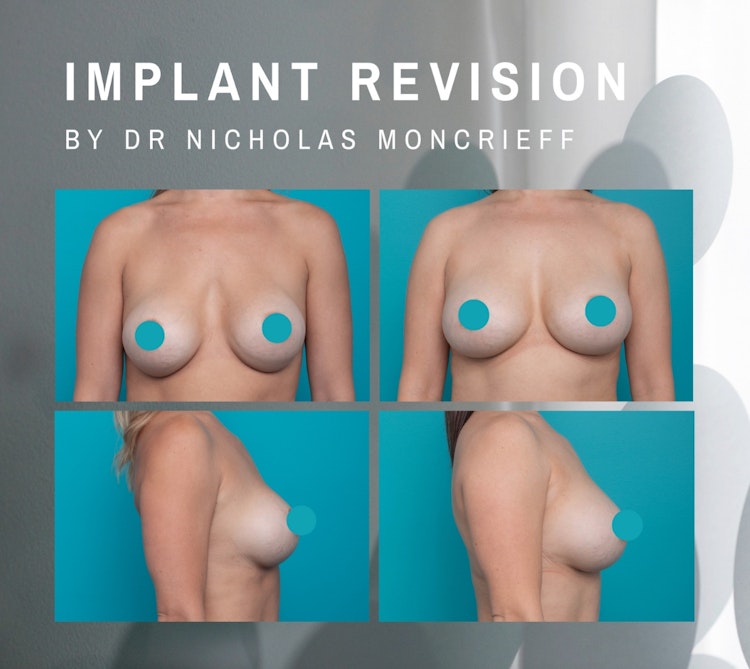 Breast Implant Replacement Result