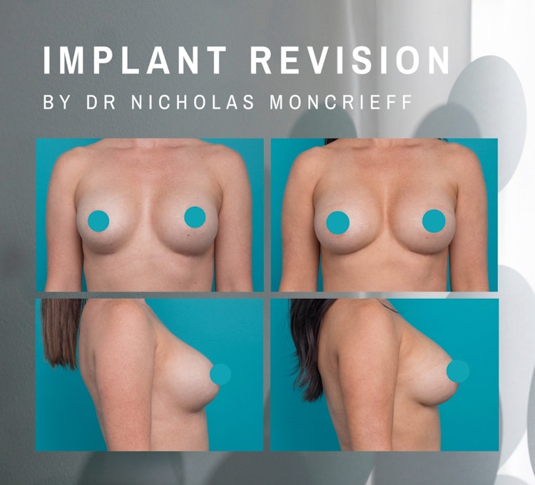 Procedures Breast BreastImplantReplacement cropped-images 37-year-old-breast-implant-replacement-patient-by-Dr-Nicholas-Moncrief-Hunter-Plastic-Surgery-Procedure-Page-46-6-1196-1084-1695620822