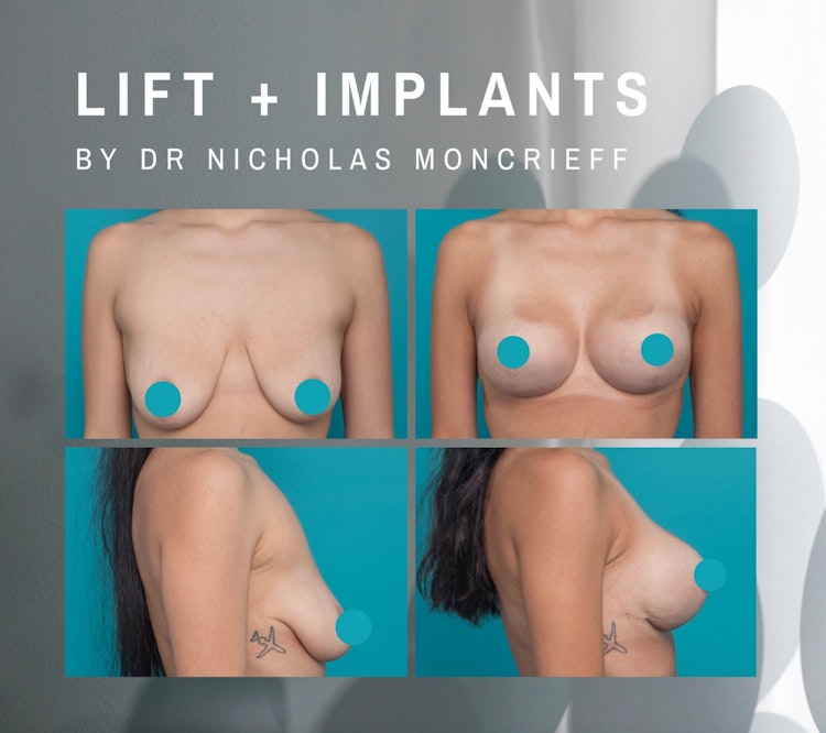 Breast Lift with Implants Dr Moncrieff results