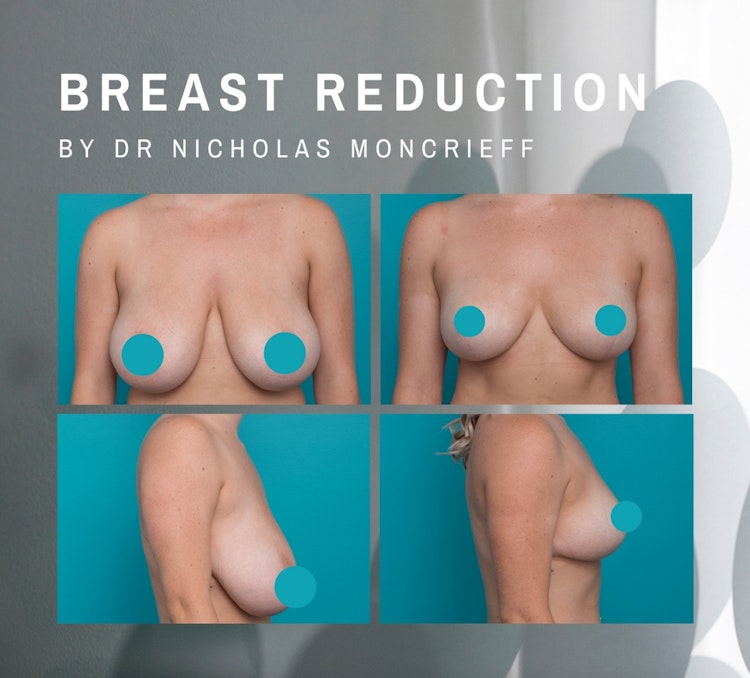 Will a Breast Lift Reduce My Cup Size? - UCI Plastic Surgery