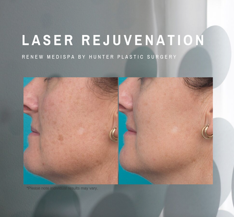 RenewMedispa Clear_Glow_facials Laser-clear-treatment-to-pigment-on-neck-and-chest-by-Hunter-Plastic-Surgery-43-yr-old-patient-6-weeks-post-pigment-last-to-the-face