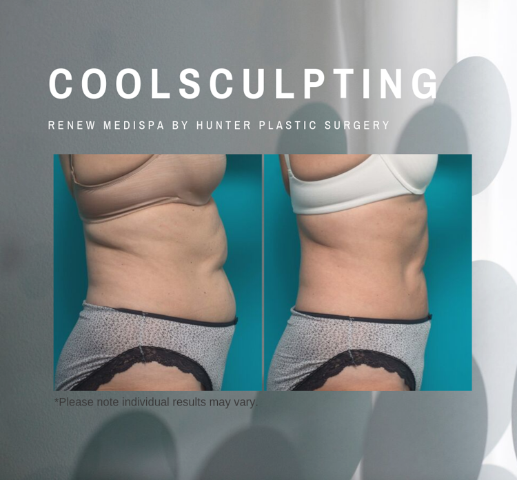 RenewMedispa CoolSculpting CoolSculpting-before-and-after-by-Hunter-Plastic-Surgery-53-yr-old-patient-10-weeks-post