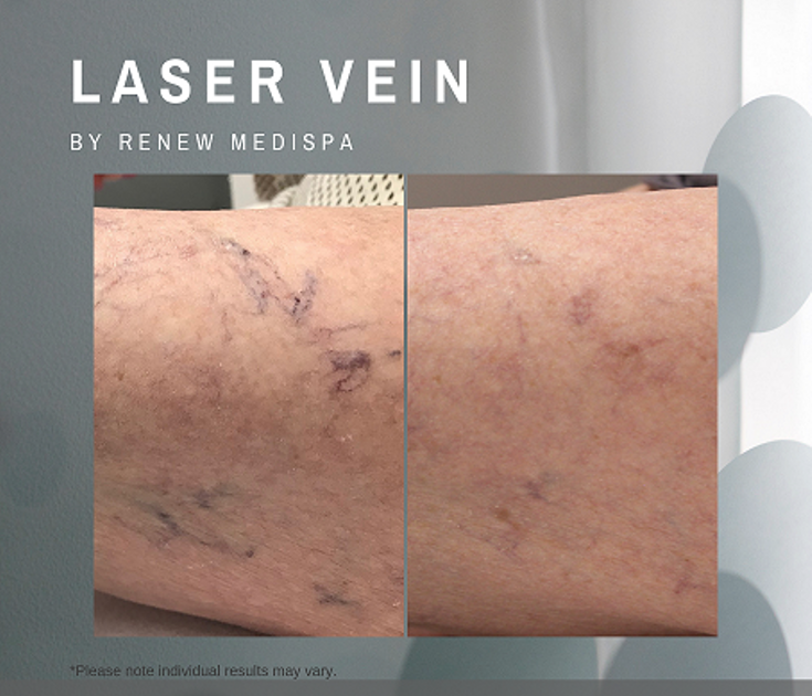 RenewMedispa Laser-Vein-Treatment Laser-vein-treatment-renew-medispa-hunter-plastic-surgery-1-treatment