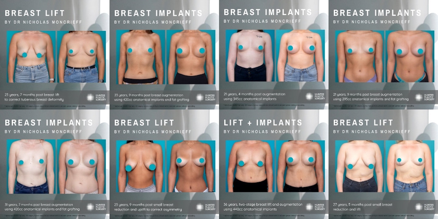 Breast Surgery for Tuberous Breasts - CosMediTour